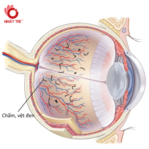 Bệnh đục dịch kính mắt có nguy hiểm không? Tư vấn giải pháp trị tối ưu