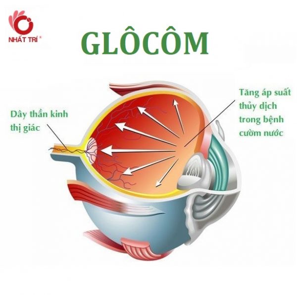 Cách nhận biết sớm bệnh glocom